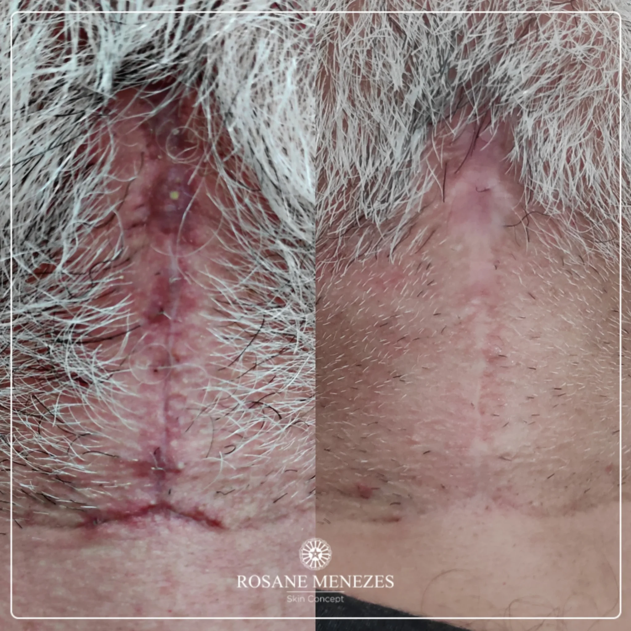 Cicatriz masculina